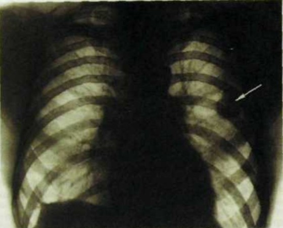 Рентгеновские снимки грудной клетки