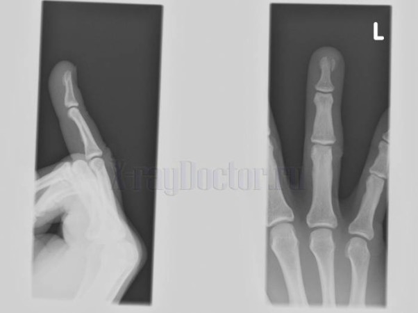 Рентген фаланги пальца