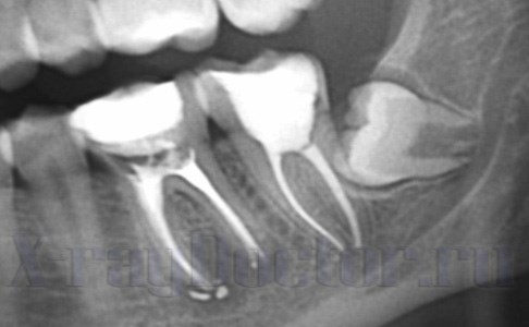 Рентгеновские снимки челюсти