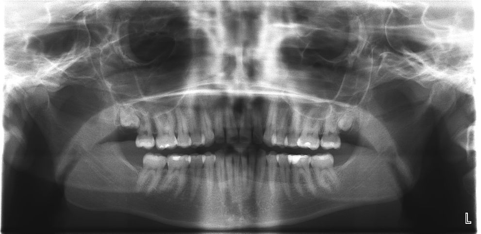 Трехмерный рентген зубов