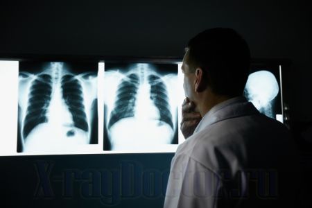 Рентген или флюорография легких что лучше